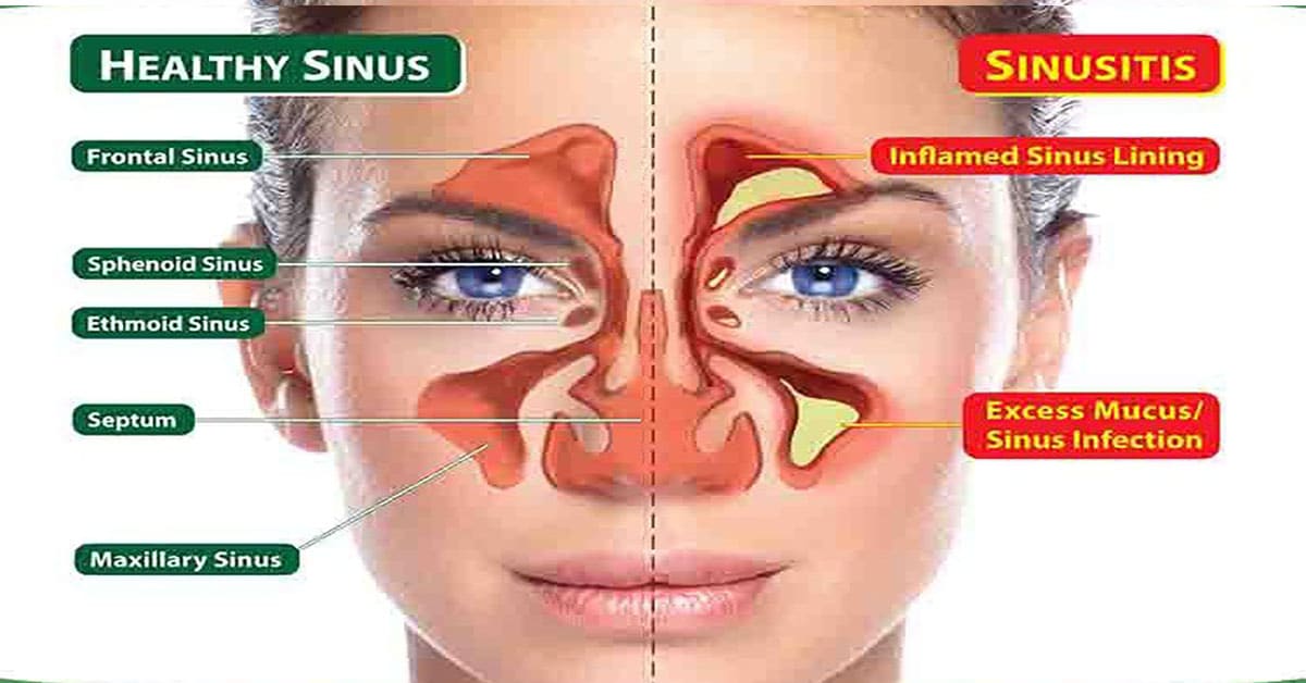 How To Clear Seriously Blocked Sinuses Naturally In Under A Minute 