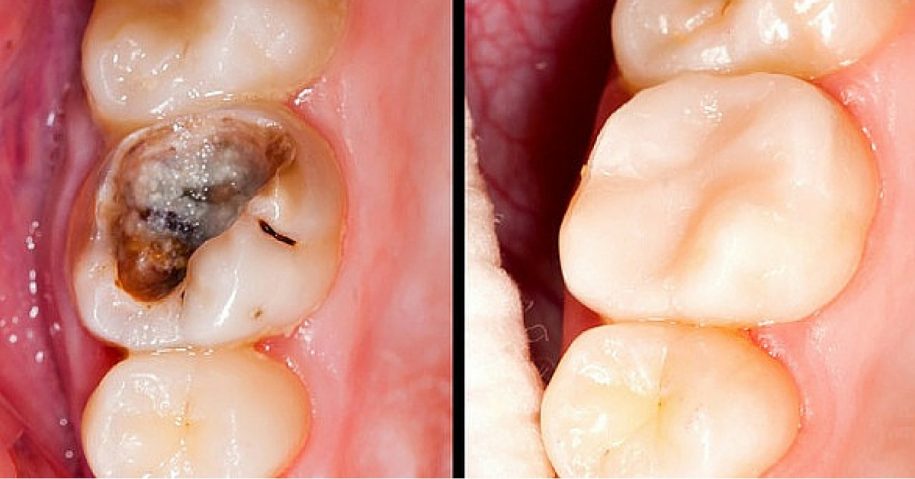 reverse-cavities-and-heal-tooth-decay-with-these-5-steps-natural-healing