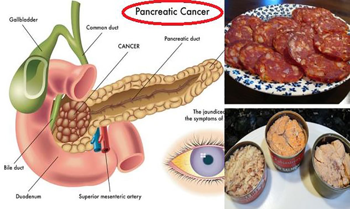 Alimentos prohibidos en el cancer de vejiga