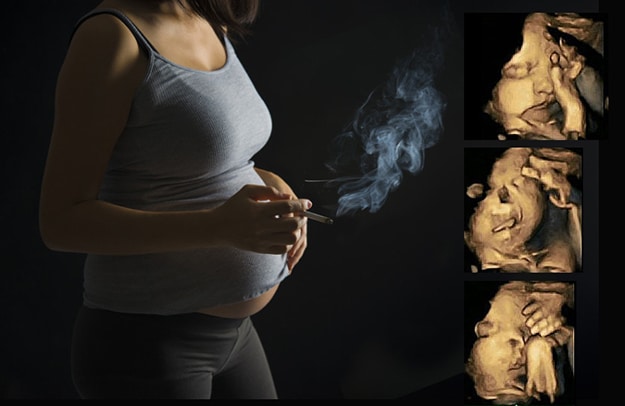 ultrasound, 4-D ultrasound, smoking during pregnancy