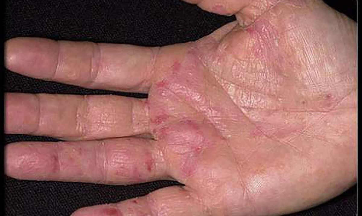 British Experts Find Cancer First Appears In Your Hands Natural Healing