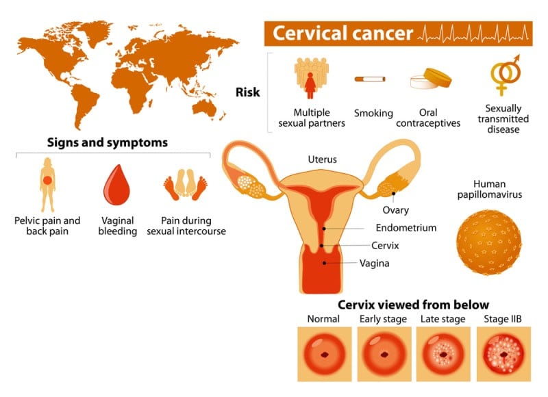 cancer, cervical cancer, gynecological cancer