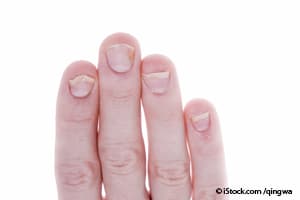 nails, nail conditions, fingernails