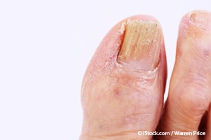 nails, nail conditions, fingernails
