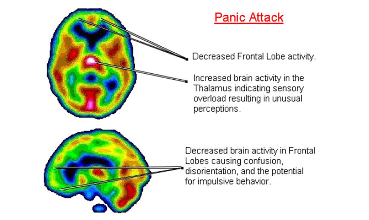 Мозг панические атаки. Мозг при панической атаке. Паническая атака головного мозга. Panic Attack. Серотонин и панические атаки.